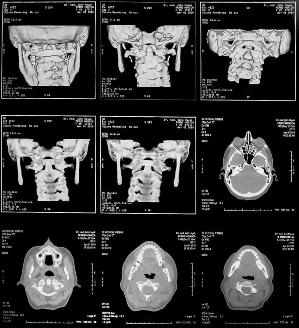 Spiral-CT / Tomographie von Schädel und Atlaswirbel
