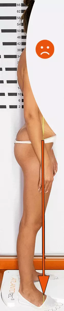 Hallux valgus Haltung vorher und nachher