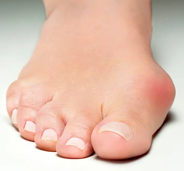 Lösungen für Hallux valgus