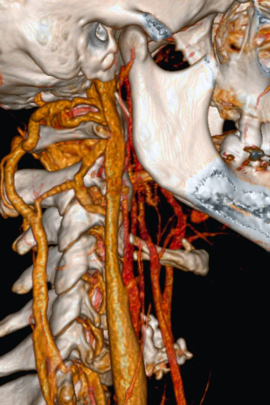 CT-Angiographie der Halswirbelsäule