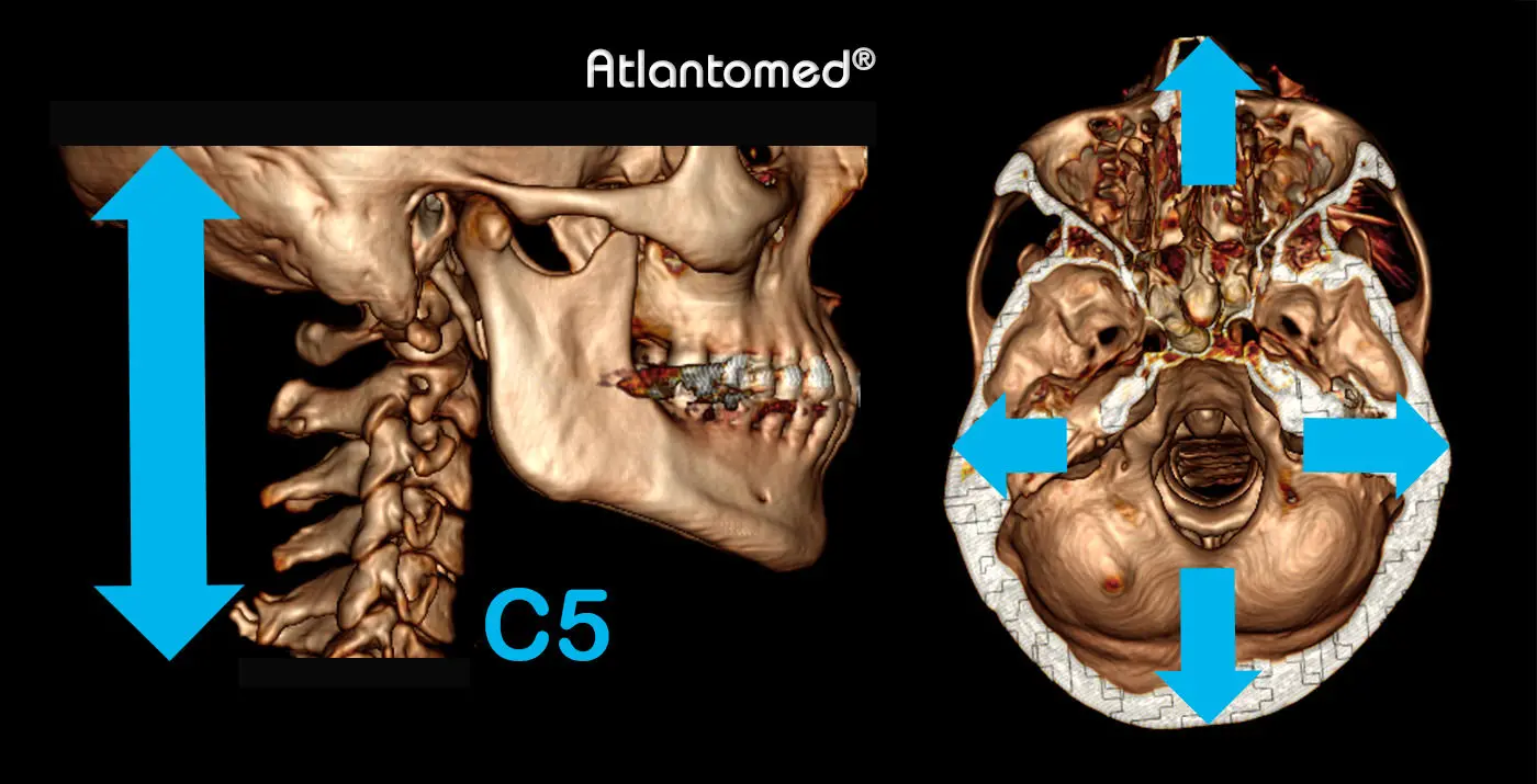 Spiral-CT des Schädels und der Halswirbelsäule mit Atlas und Axis