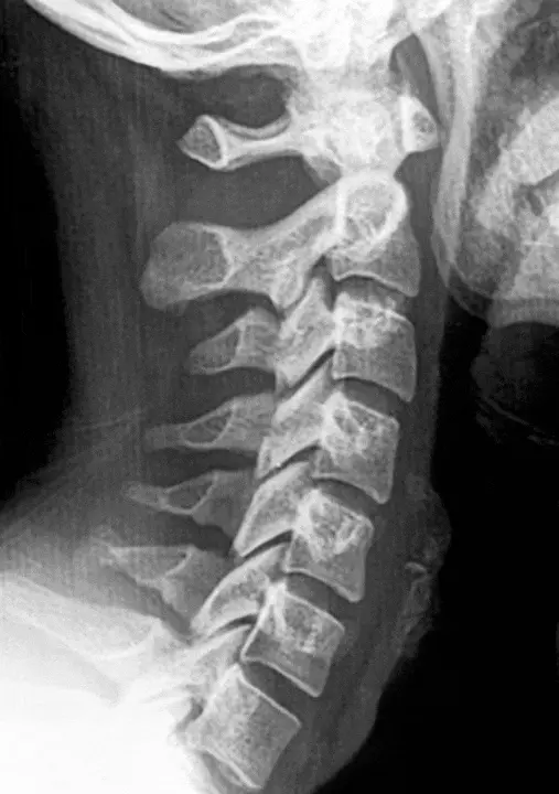 Aufrichtung der Halswirbelsäule nach Schleudertrauma